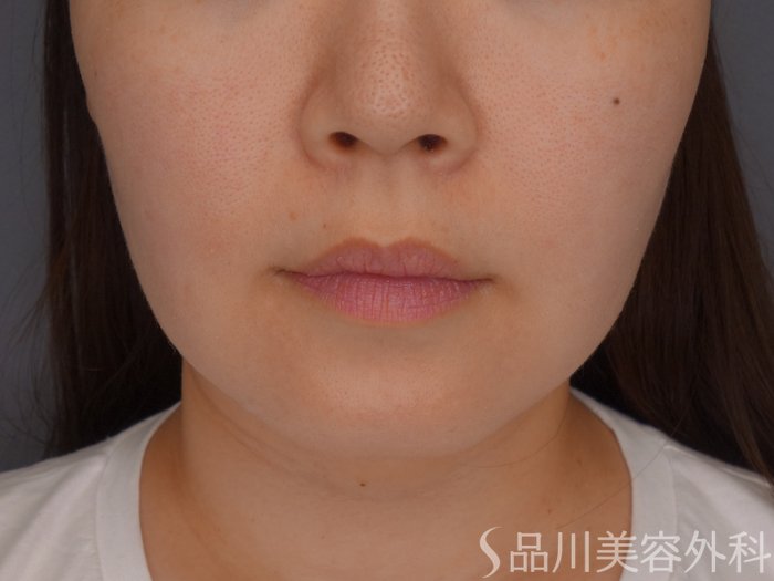 症例NO.65300のBEFORE写真