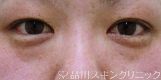 症例NO.62020のBEFORE写真