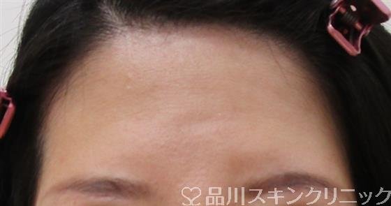 症例NO.42337のBEFORE写真