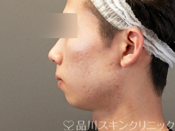症例NO.65380のBEFORE写真
