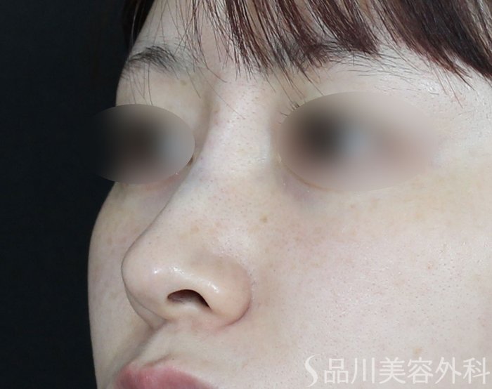 症例NO.65664のAFTER写真