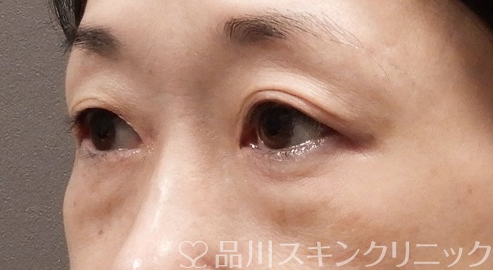 症例NO.69557のBEFORE写真
