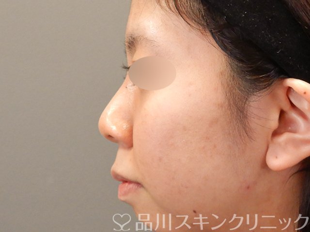 症例NO.75198のBEFORE写真