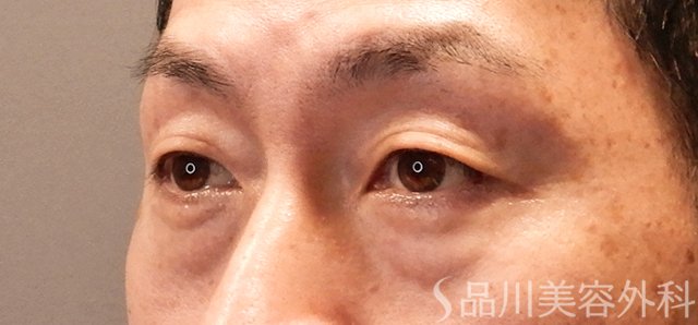 症例NO.70550のBEFORE写真