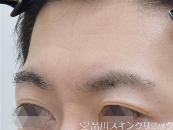 症例NO.59325のBEFORE写真