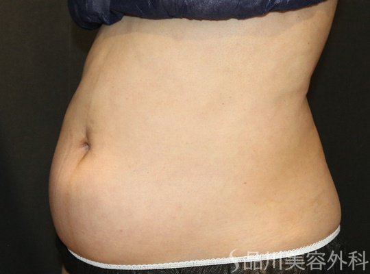 症例NO.73513のBEFORE写真