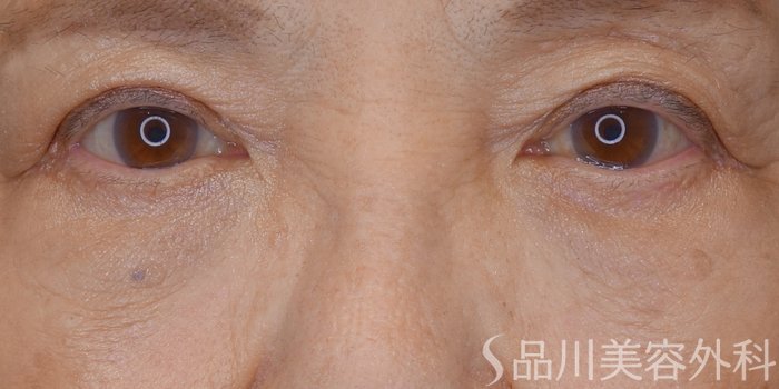 症例NO.72748のAFTER写真