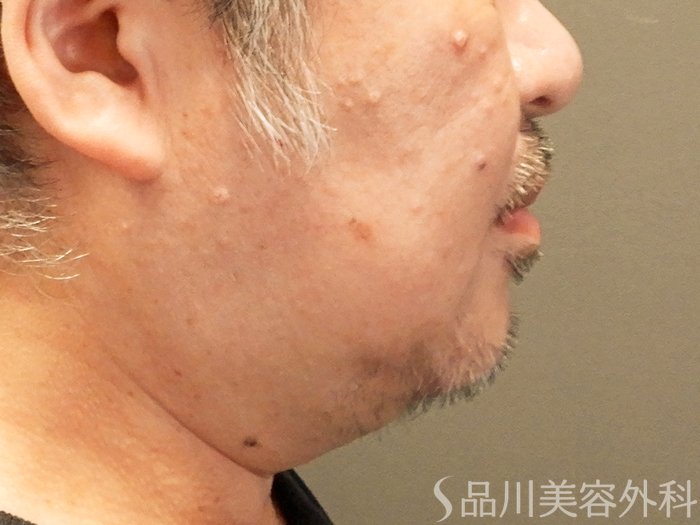 症例NO.67662のAFTER写真