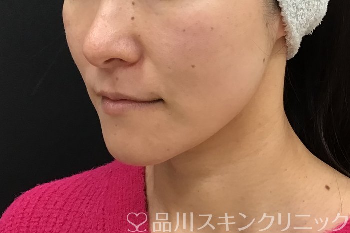 症例NO.71545のAFTER写真