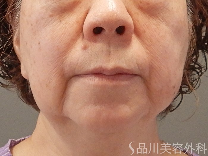 症例NO.70442のBEFORE写真