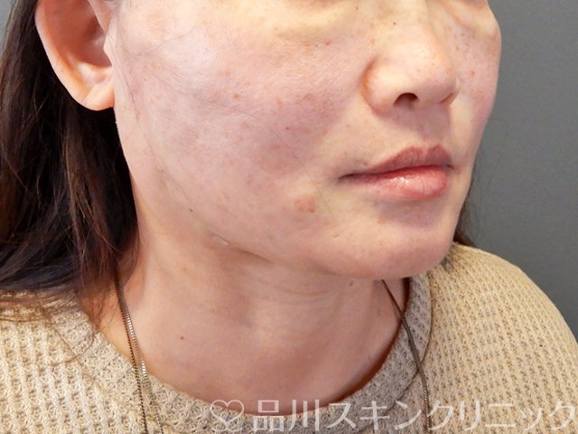 症例NO.67831のAFTER写真