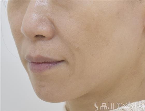 症例NO.51124のAFTER写真