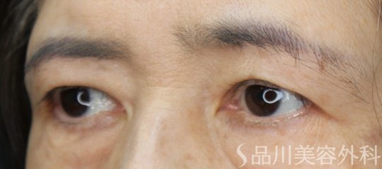 症例NO.74478のAFTER写真