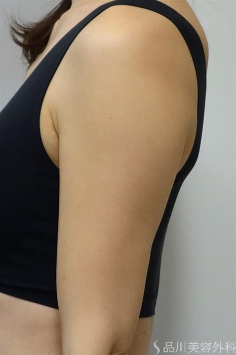 症例NO.42214のBEFORE写真
