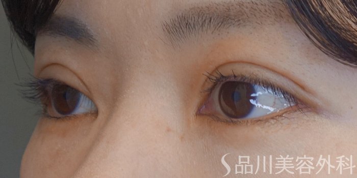 症例NO.72320のAFTER写真