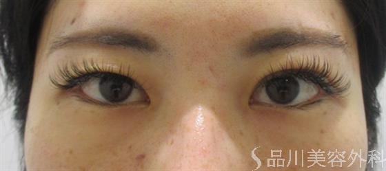 症例NO.37200のBEFORE写真