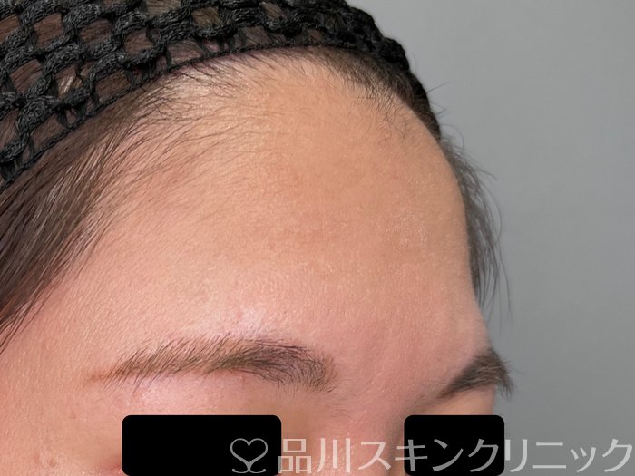 症例NO.70091のBEFORE写真