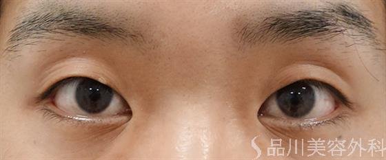 症例NO.50930のBEFORE写真