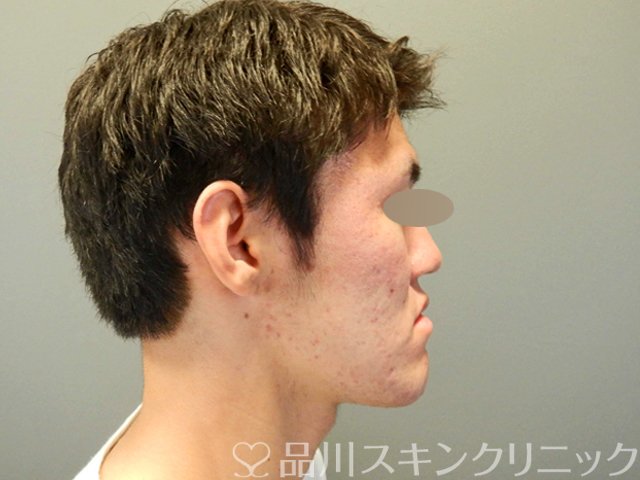 症例NO.69061のBEFORE写真