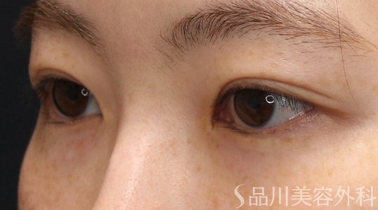 症例NO.74368のAFTER写真