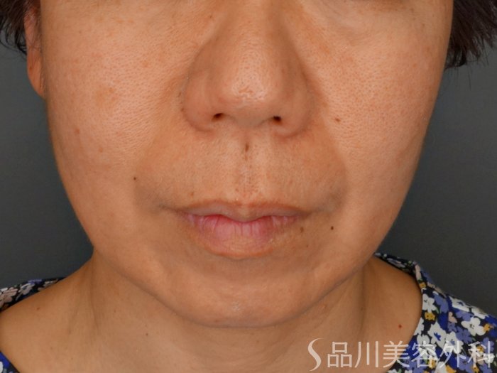 症例NO.74049のBEFORE写真