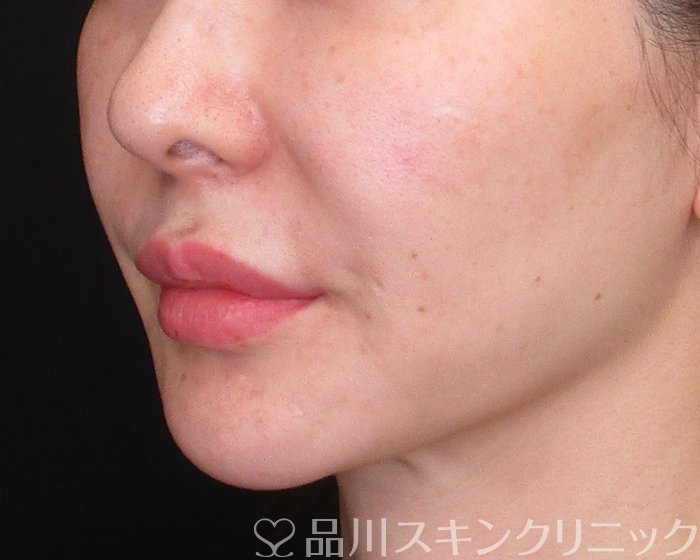 症例NO.75266のBEFORE写真