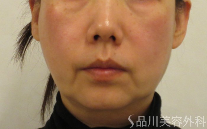 症例NO.73220のBEFORE写真