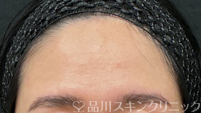 症例NO.74384のBEFORE写真