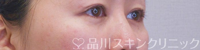 症例NO.71412のAFTER写真