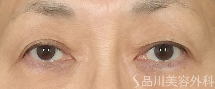 症例NO.71564のBEFORE写真