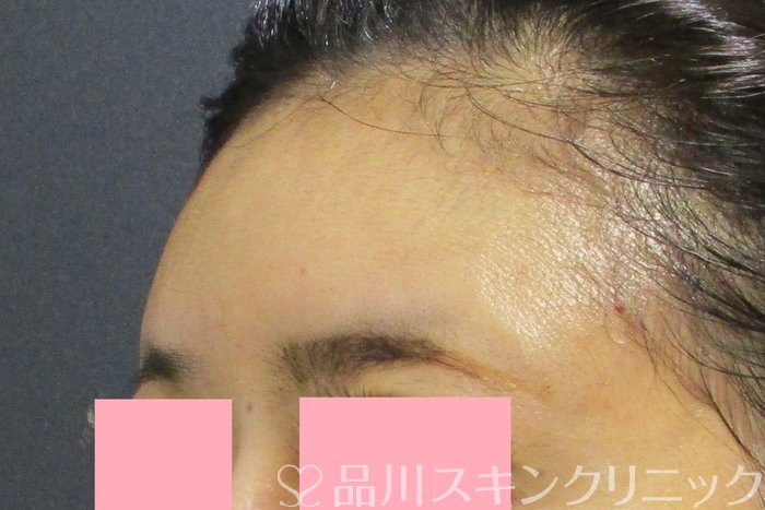 症例NO.74240のAFTER写真
