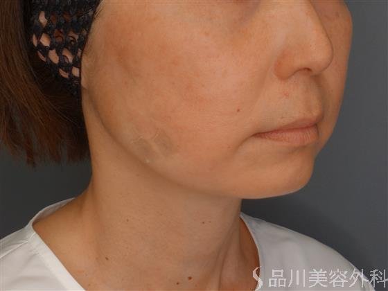 症例NO.60862のAFTER写真