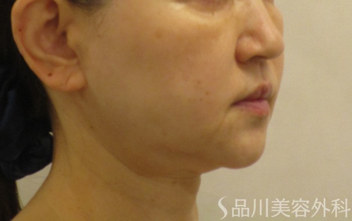 症例NO.65700のBEFORE写真