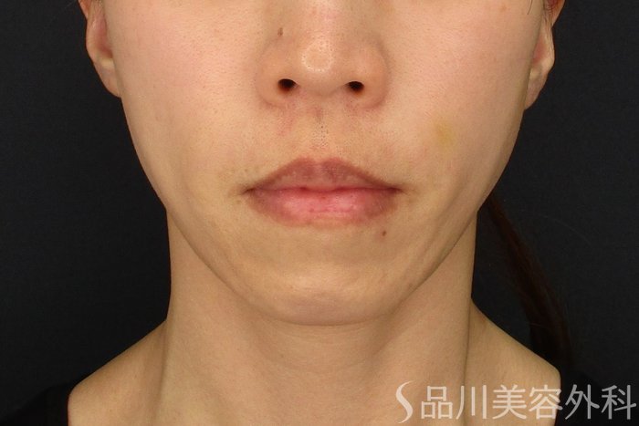 症例NO.70599のAFTER写真