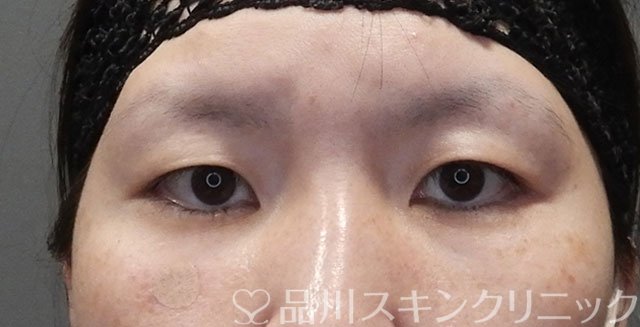 症例NO.75077のBEFORE写真