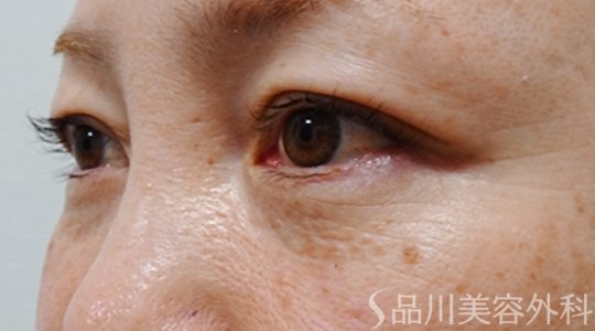 症例NO.74141のAFTER写真