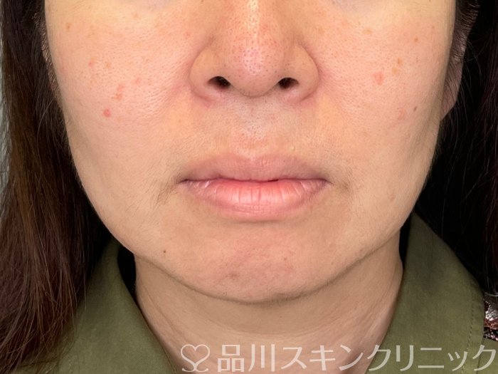 症例NO.69460のBEFORE写真