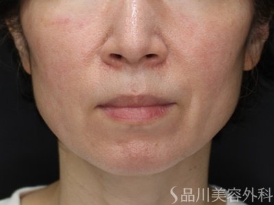 症例NO.68687のBEFORE写真