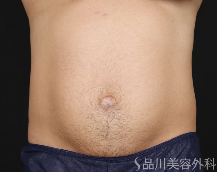 症例NO.71756のAFTER写真