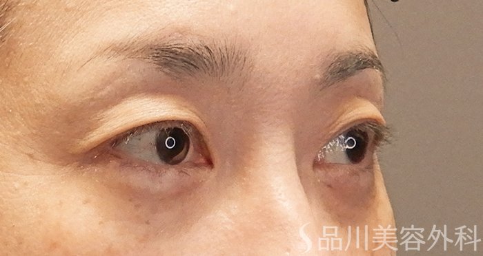 症例NO.70973のAFTER写真