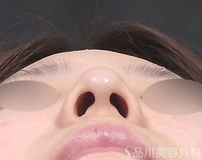 症例NO.65346のBEFORE写真