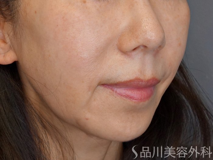 症例NO.73927のBEFORE写真