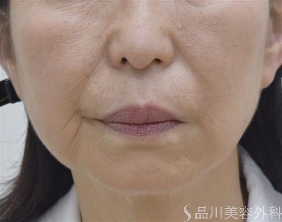 症例NO.51900のAFTER写真