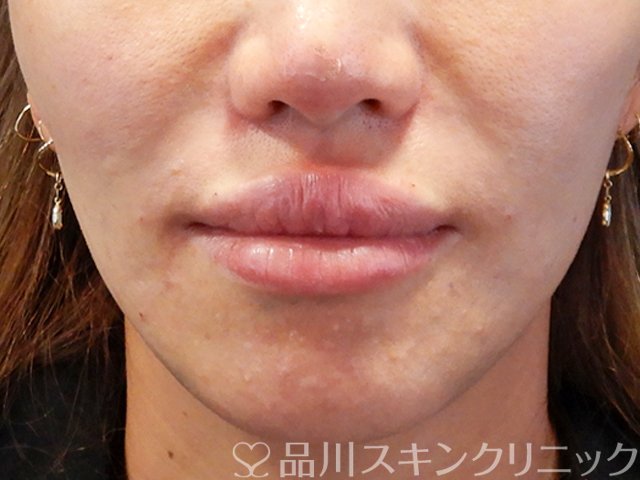 症例NO.71241のAFTER写真
