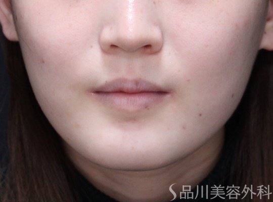 症例NO.65655のBEFORE写真