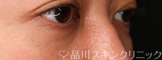 症例NO.69658のAFTER写真
