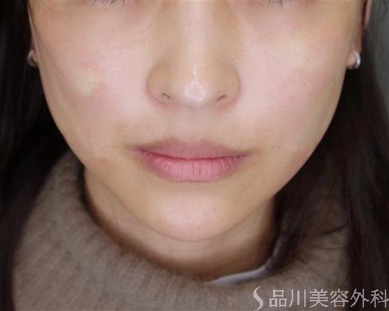 症例NO.49504のAFTER写真