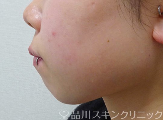症例NO.64622のBEFORE写真