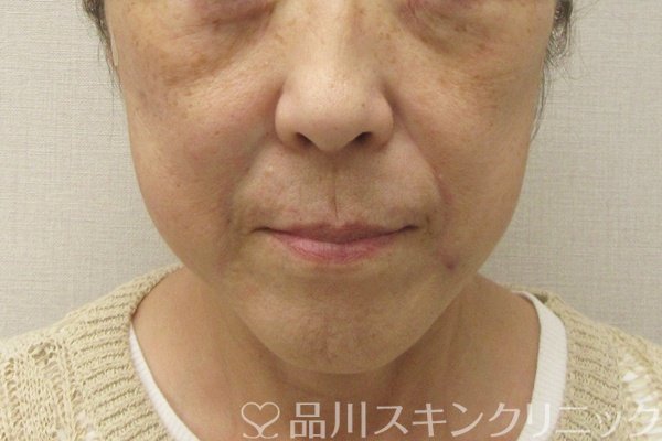 症例NO.75072のAFTER写真