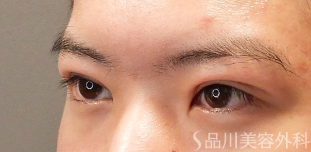 症例NO.72454のAFTER写真